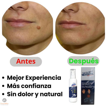 Wart Remover - Di Adiós a las Verrugas Sin Complicaciones Ni Esperas